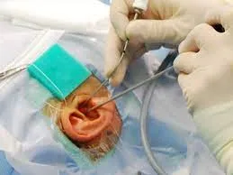 Ear Surgeries (Microscopic and Endoscopic) image 1