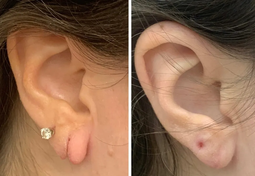 Ear Procedures like Reconstruction and Piercing image 1