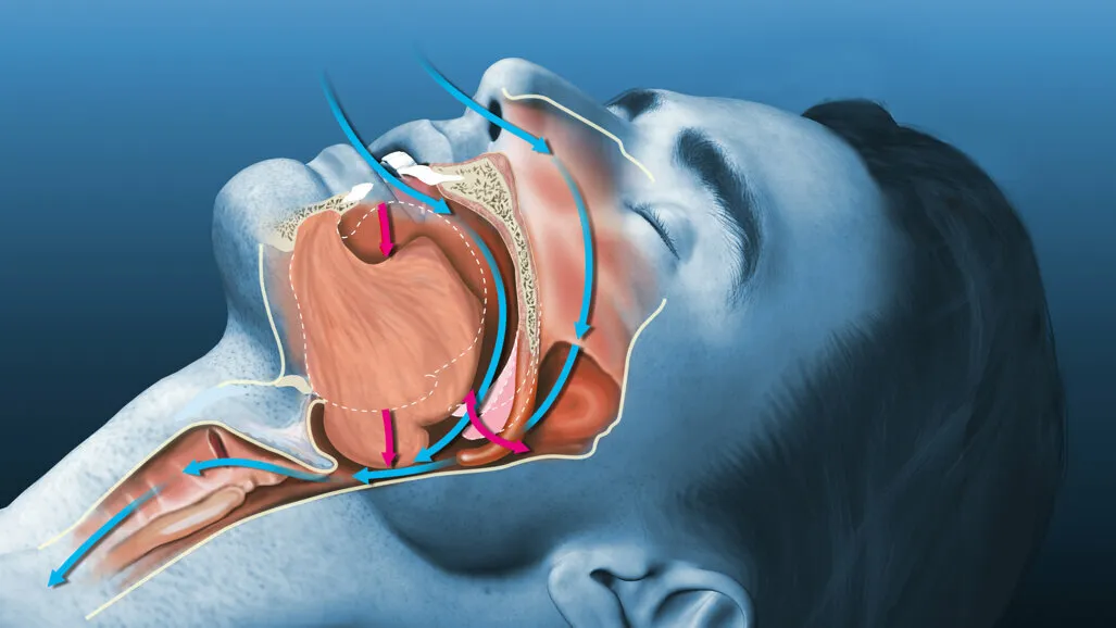 Sleep Apnea Surgery image 1