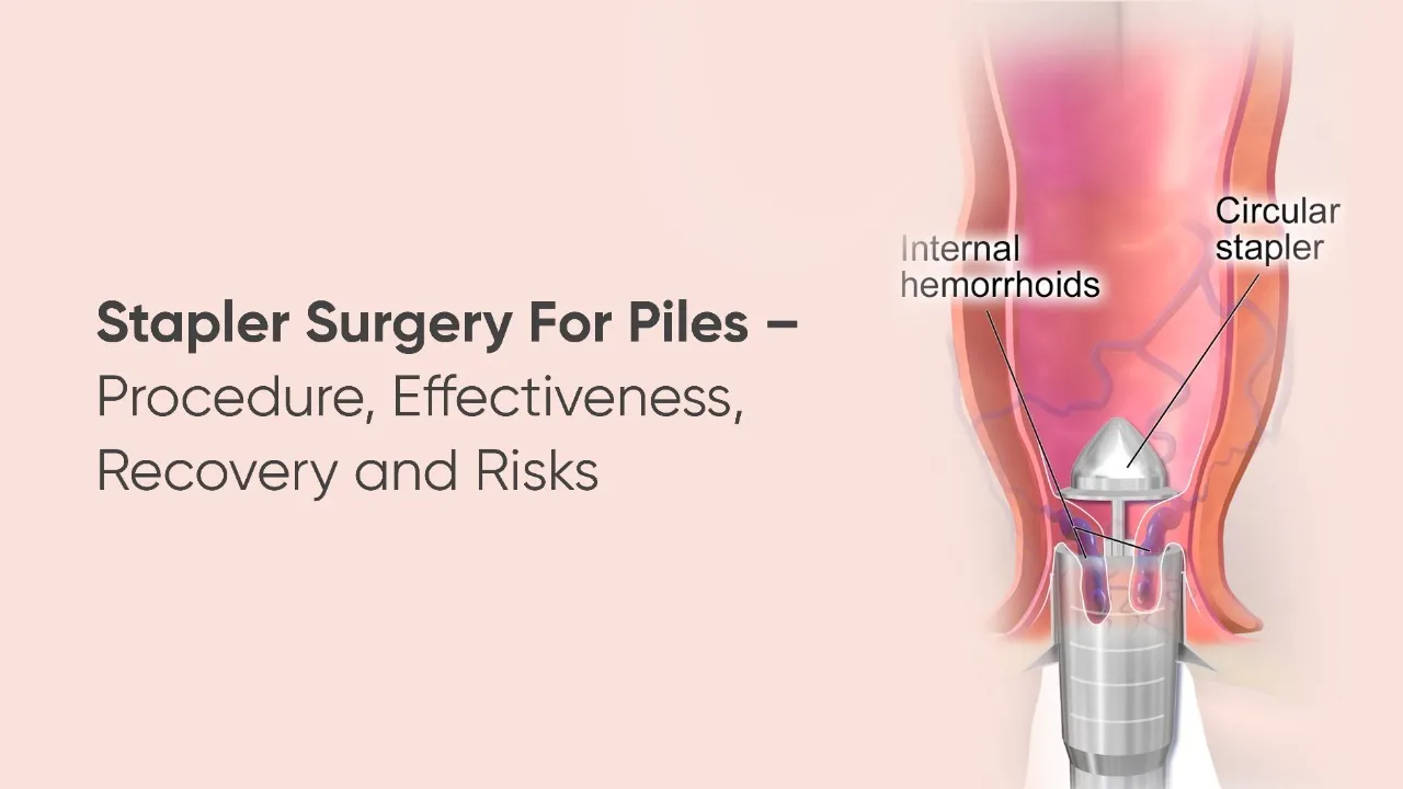 Piles Stapler Surgery image 1