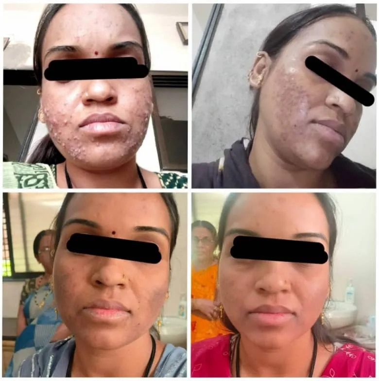 PRP Therapy For Acne And Acne Scar  image 1