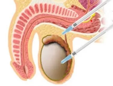 Surgical Sperm Retrieval image 1