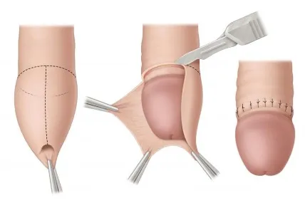 Stapler Circumcision image 1