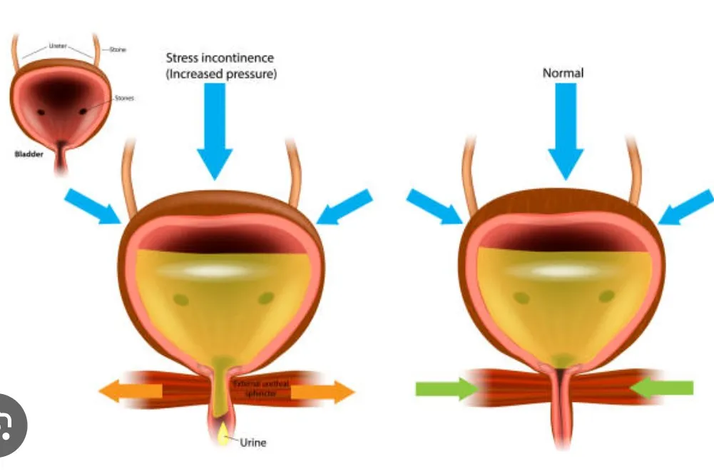 Urinary Leak image 1