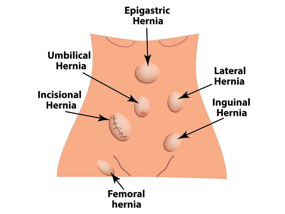 Hernia Surgery image 1