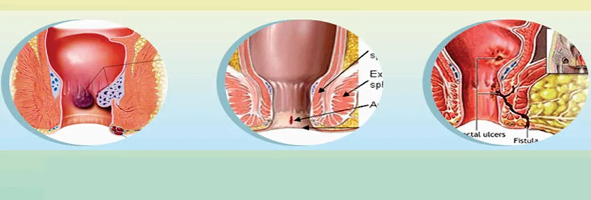 Piles, Fissure & Fistula Surgery image 1