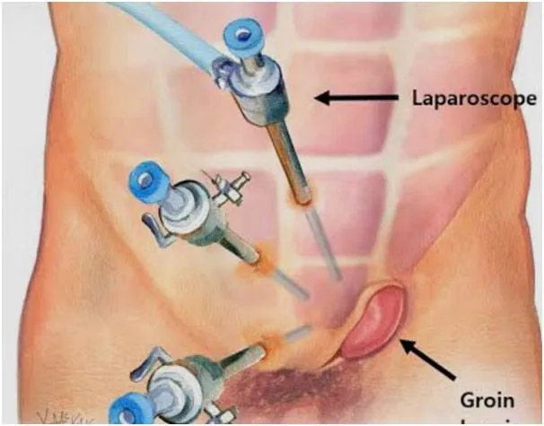 Laparoscopic Hernia Surgery image 1