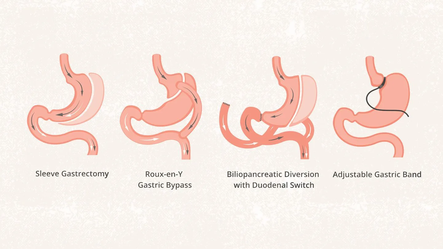 Bariatric Surgery image 1