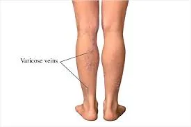 Varicose Vein image 1