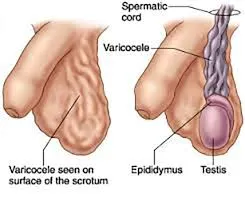 Testicular surgeries image 1