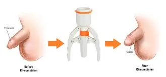 Foreskin surgeries image 1
