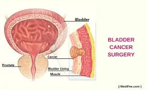 Bladder Cancer surgery and treatment image 1