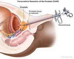 Prostate Cancer surgery and treatment image 1