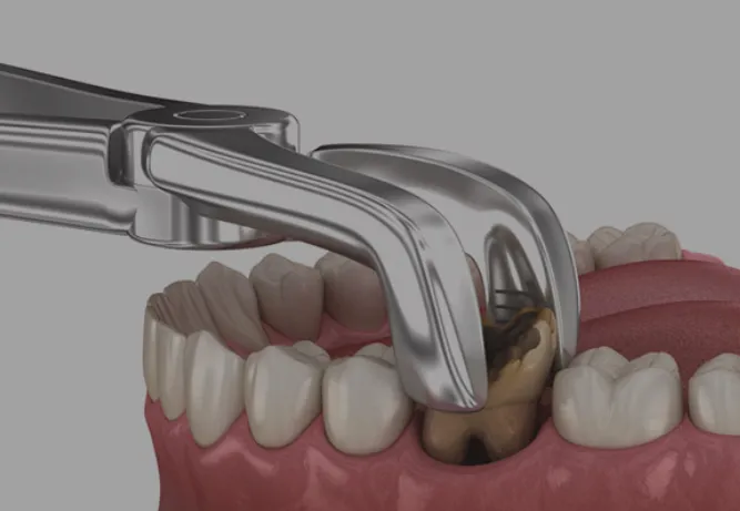 Dental Surgical Extraction image 1