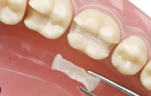 Cosmetics Restoration / Fillings  image 1