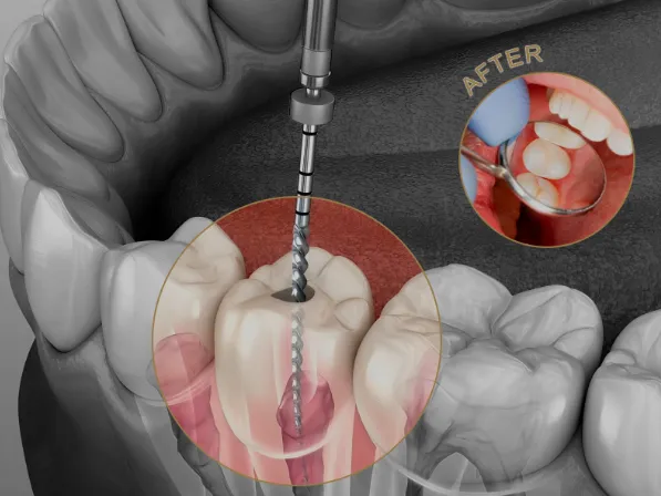 Advance Root Canal image 1