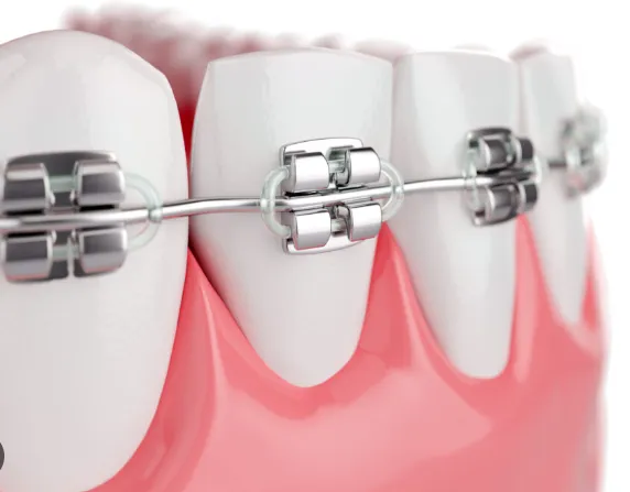 Fixed Orthodontic Treatments  image 1