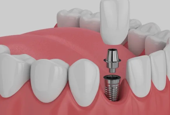 Dental Implant image 1