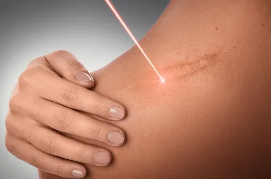 SCAR REDUCTION image 1