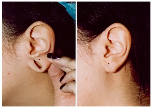 EAR LOBE REPAIR image 1