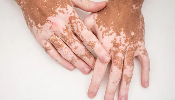 VITILIGO SURGERY image 1