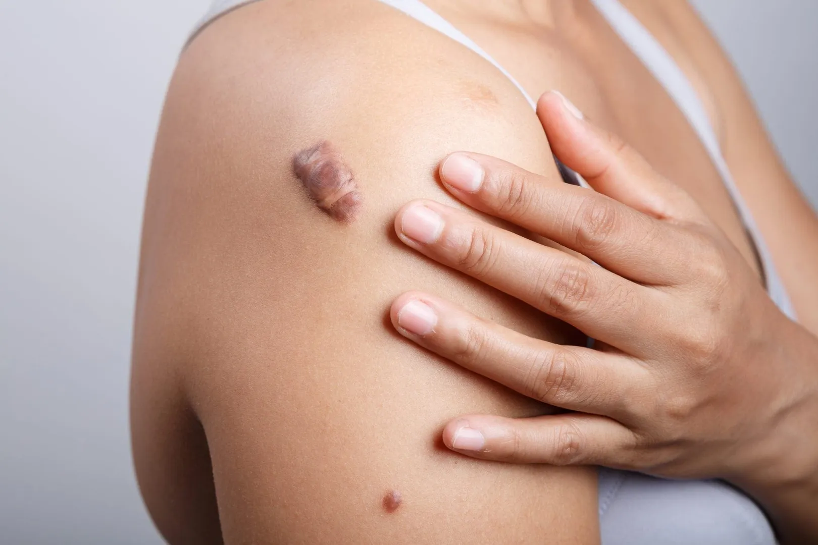 KELOID REDUCTION image 1