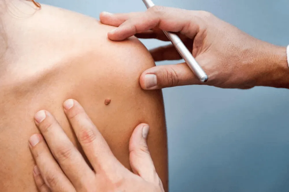 SKIN TAGS REMOVAL image 1