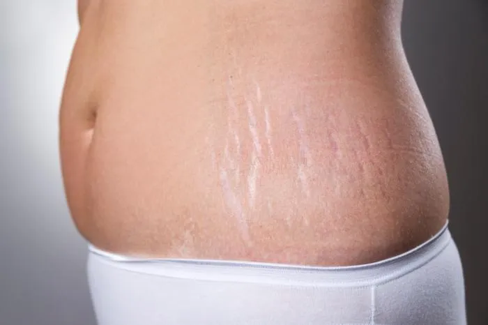 STRETCH MARK REDUCTION image 1