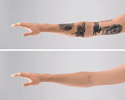 TATTOO REMOVAL image 1