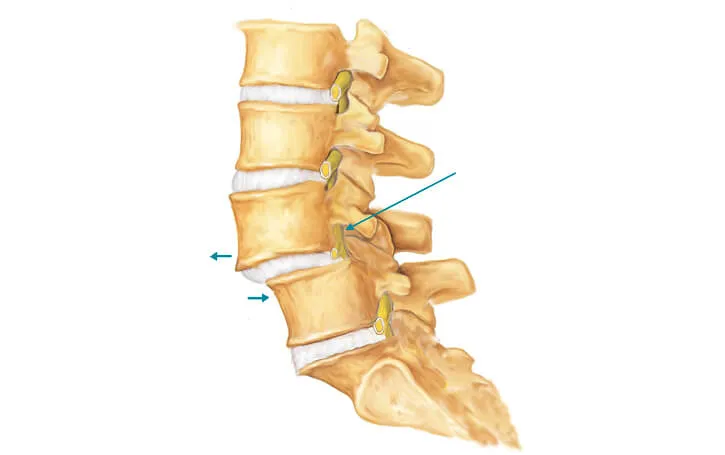 Spondylolisthesis Treatment in Pune image 1