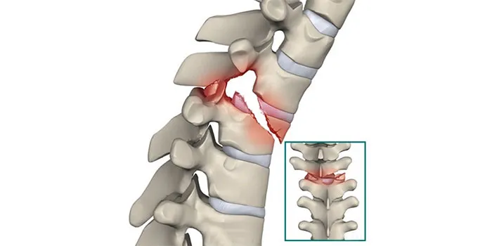 Spine Fracture Treatment in Pune image 1