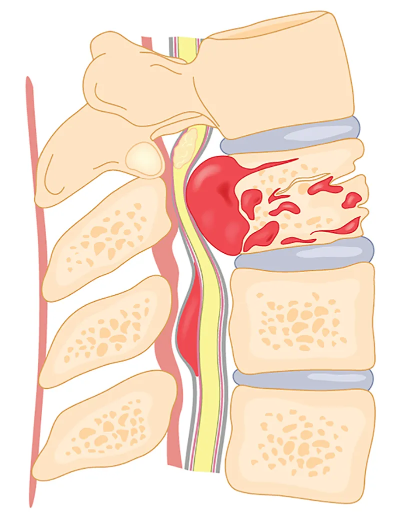 Spine Tumor Treatment in Pune image 1
