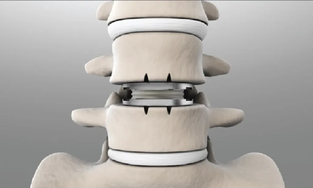 Disc Replacement Surgery Specialist in Pune image 1