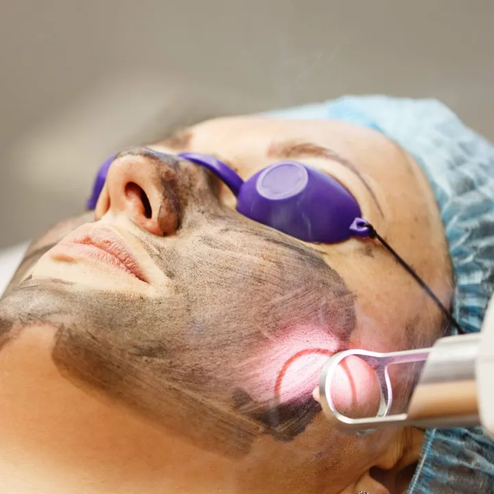 Carbon Laser Facial Treatment in Thane image 1