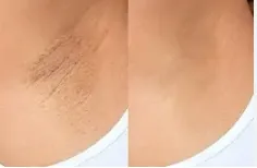 UNDERARM PEEL image 1