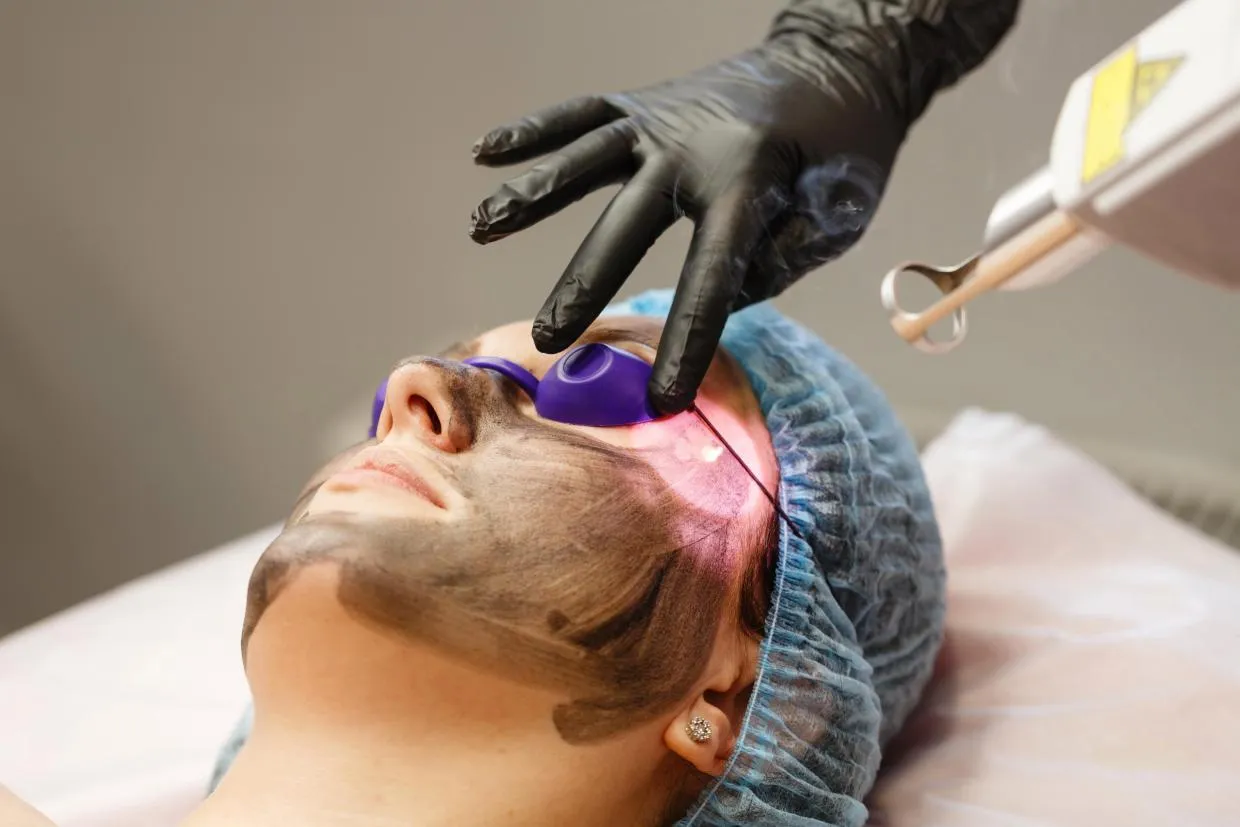 CARBON PEEL image 1