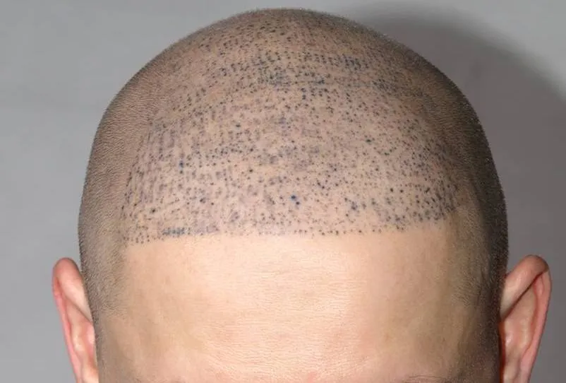 SCALP MICROPIGMENTATION image 1