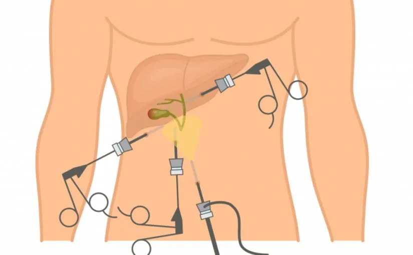 Gallbladder Surgery image 1