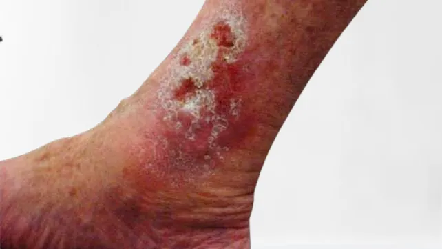 Leg Ulcers Treatment in Pune image 1