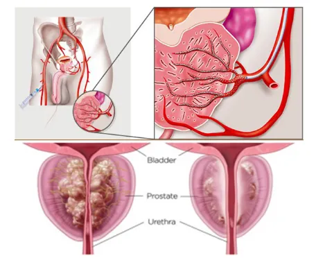 Prostate Artery Embolization Treatment in Pune image 1