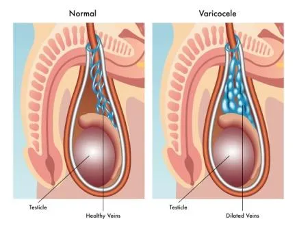 Varicocele Embolization Treatment in Pune image 1
