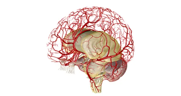 Neurovascular Interventions Treatment in Pune image 1