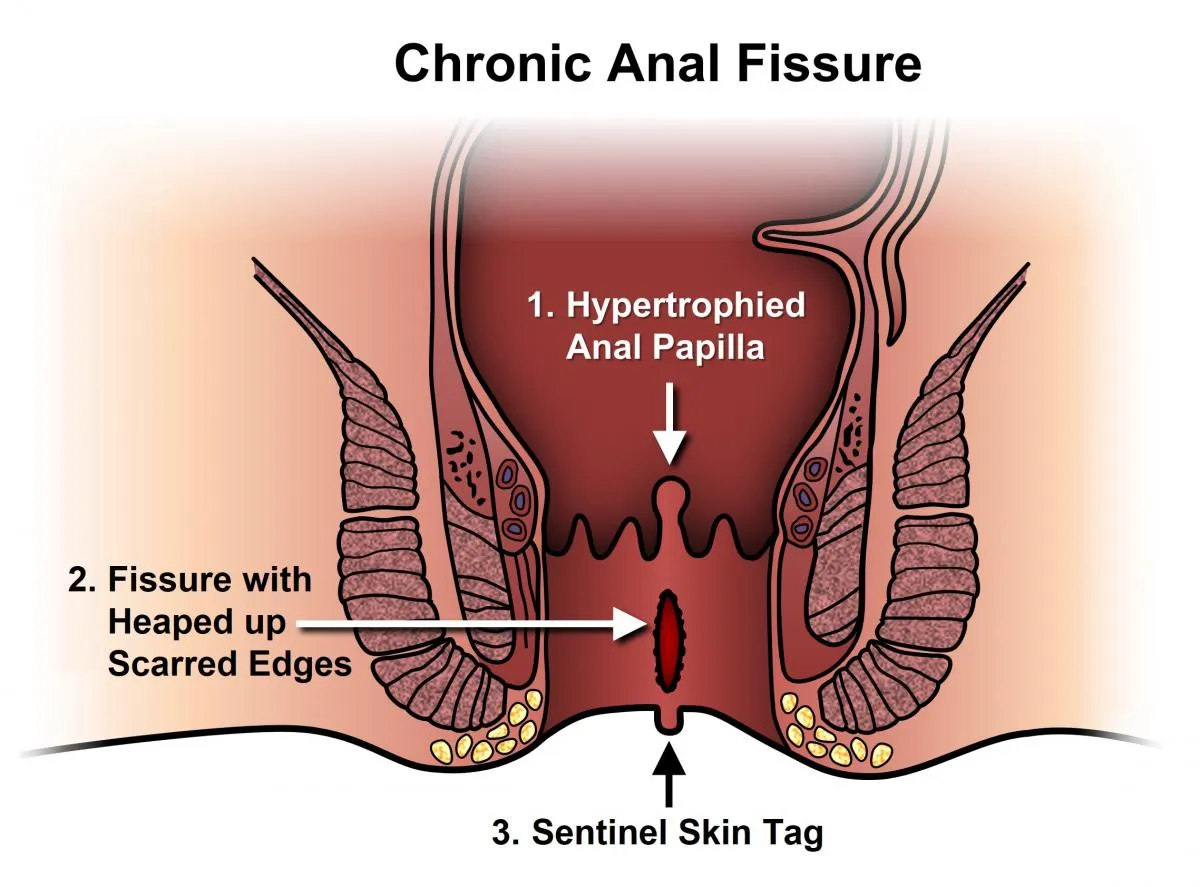 Treatment for Fissure image 1