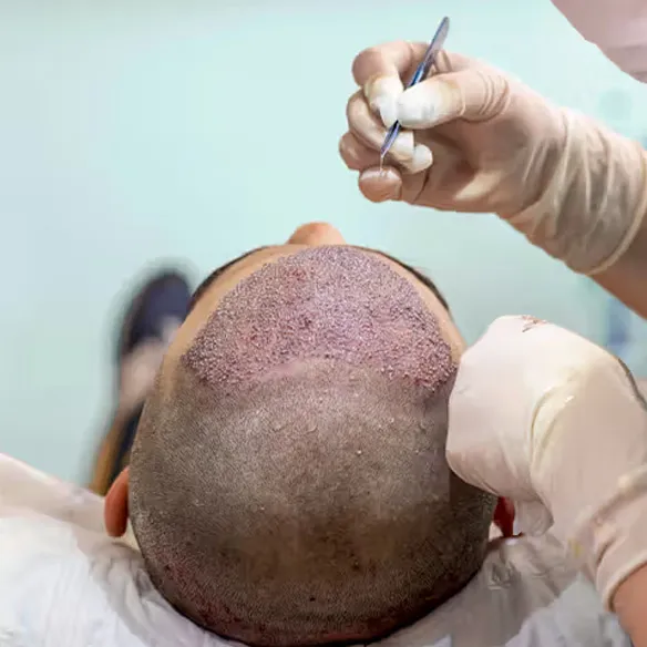 Bio FUE Hair Transplant in Thane image 1