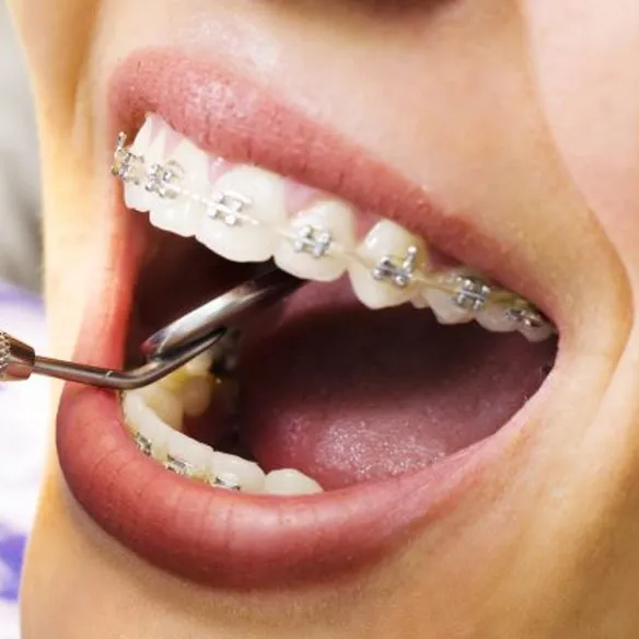 Braces Treatment in Thane image 1