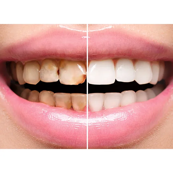Root Canal in Thane image 1