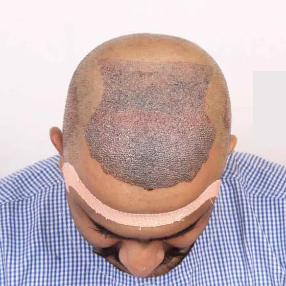 Interlocking F.U.E. Hair Transplant in Thane image 1