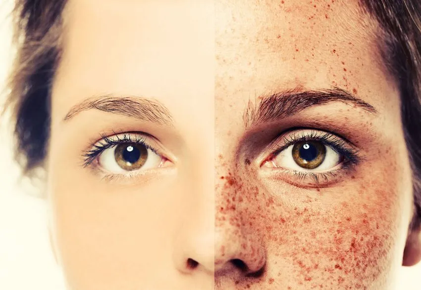 Freckles Removal Treatment image 1