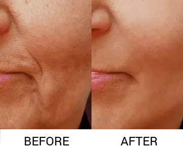 Hifu Treatment  Treatment image 1