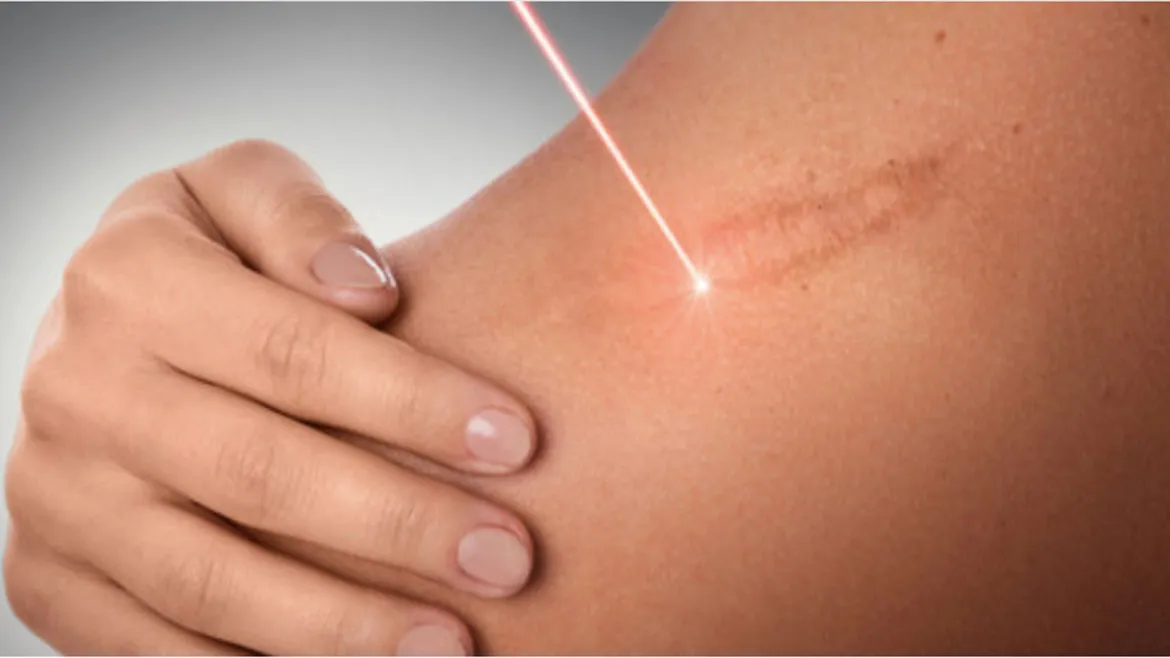 Burn Scar Removal Treatment  image 1